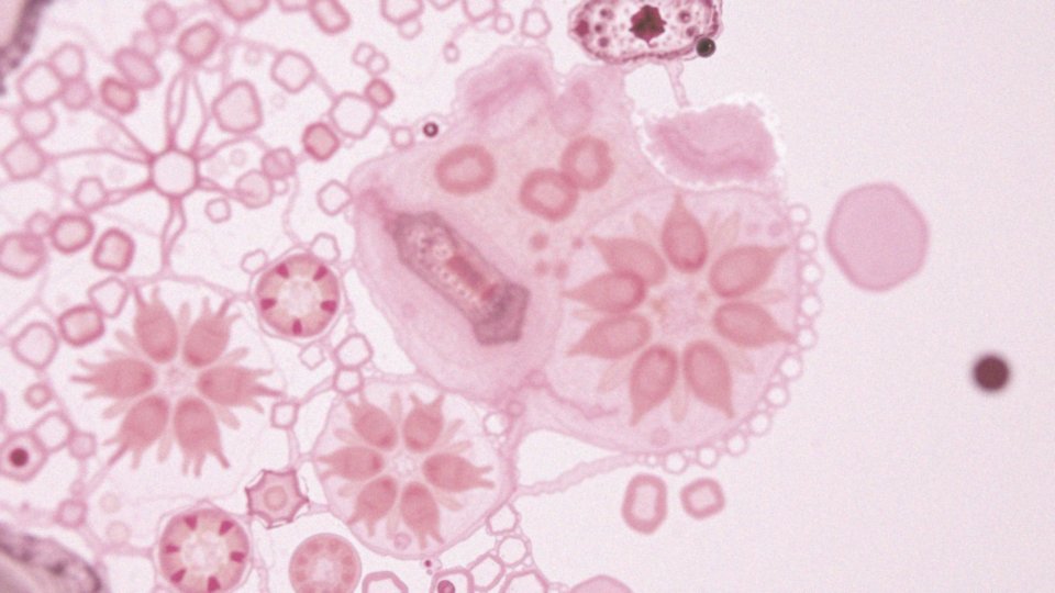Jakie są powiązania między Helicobacter pylori a metaplazją?