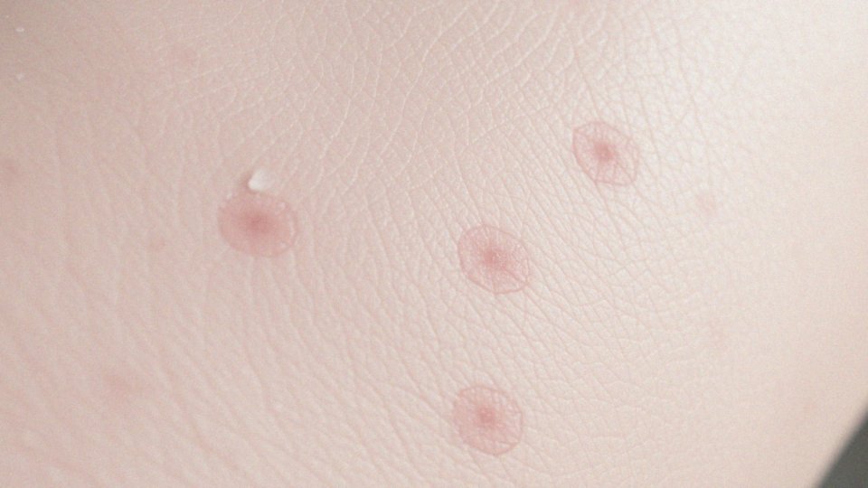 Usuwanie blizn laserem – skuteczna metoda poprawy wyglądu skóry